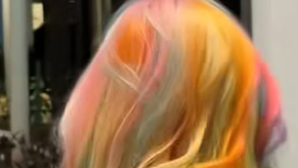 00后追星女孩頻繁染發(fā)，雙腿長(zhǎng)滿紅斑確診腎炎