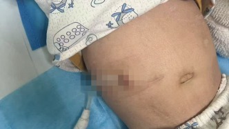 試管嬰兒出生不久確診腎病綜合征：醫(yī)院被判擔(dān)責(zé)10%，再審后發(fā)回重審