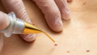 身上有痣要不要點？有這幾個特點的要小心