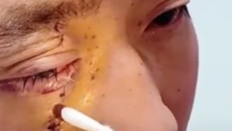 雙目受傷卻守護16名乘客的駕駛員李林保住了左眼，右眼分步康復