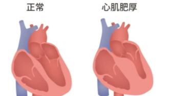 科普 | 左心室肥厚、冠心病、心衰……别被高血压伤了心