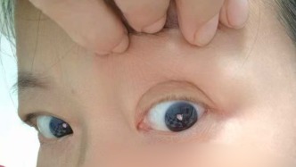 51歲阿姨稱割雙眼皮失敗無法修復(fù)，衛(wèi)健部門回應(yīng)