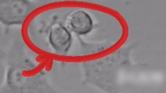 女生意外拍到肿瘤细胞分裂全过程，网友：能当教材配套视频！