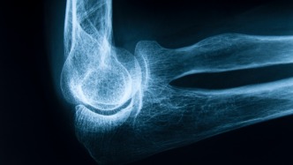 只是“缺鈣”而已？專家：骨質疏松髖部骨折1年內死亡率達20%