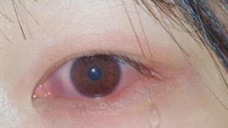 關(guān)節(jié)炎非白塞病孤立癥狀，常是多系統(tǒng)受累，致盲和血管炎風(fēng)險信號