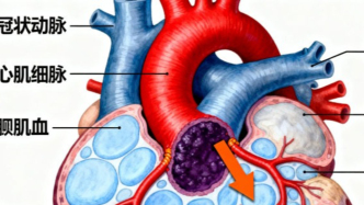 心梗并非突然來襲，早期跡象需警惕