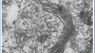 识病寻源｜Barth综合征的疗法突破：罕见病需要被看见