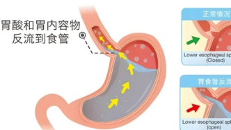徐浦脾胃专病：胃食管反流为何久治不愈？您可能忽略了这些“隐形帮凶”
