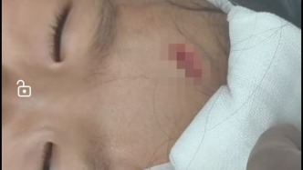 女童在客房摔倒額頭縫十余針，家長稱因床鋪尖銳物造成要求酒店擔責(zé)