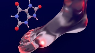 科普｜年輕人也要警惕痛風，管住嘴是基礎，規(guī)范治療是關鍵