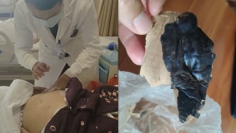 72岁阿婆喝一个月“养生水”，腹胀抽出上万毫升腹水