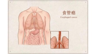 總覺得嗓子眼有東西，咳又咳不出？醫(yī)生：趕緊做胃鏡