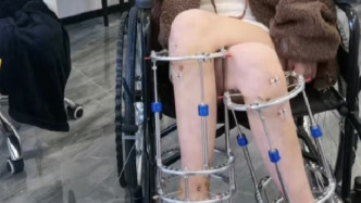 “断骨增高术”宣介在多平台重现，有账号诱导美容者去国外手术