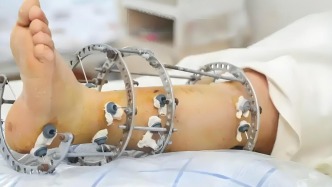 澎湃回声｜“断骨增高术”宣介在多平台重现，澎湃报道后多个账号被封