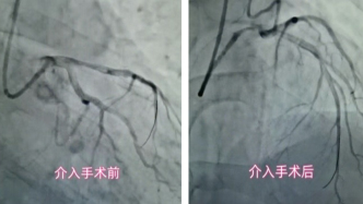 案例 | 45歲患者突發(fā)心梗，一體化胸痛救治體系接力救“心”