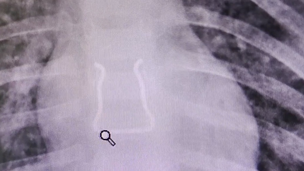 幼童誤吞“Ω”形金屬鉤，醫(yī)生“反向操作”助其脫險(xiǎn)