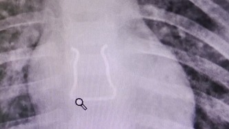 幼童誤吞“Ω”形金屬鉤，醫(yī)生“反向操作”助其脫險