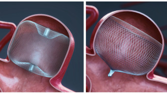 上海今年首款Ⅲ類創(chuàng)新醫(yī)療器械獲批上市，用于動(dòng)脈瘤血管內(nèi)治療