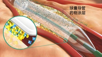 第六批國家組織高值醫(yī)用耗材集采開標，臨床主流產(chǎn)品普遍中選