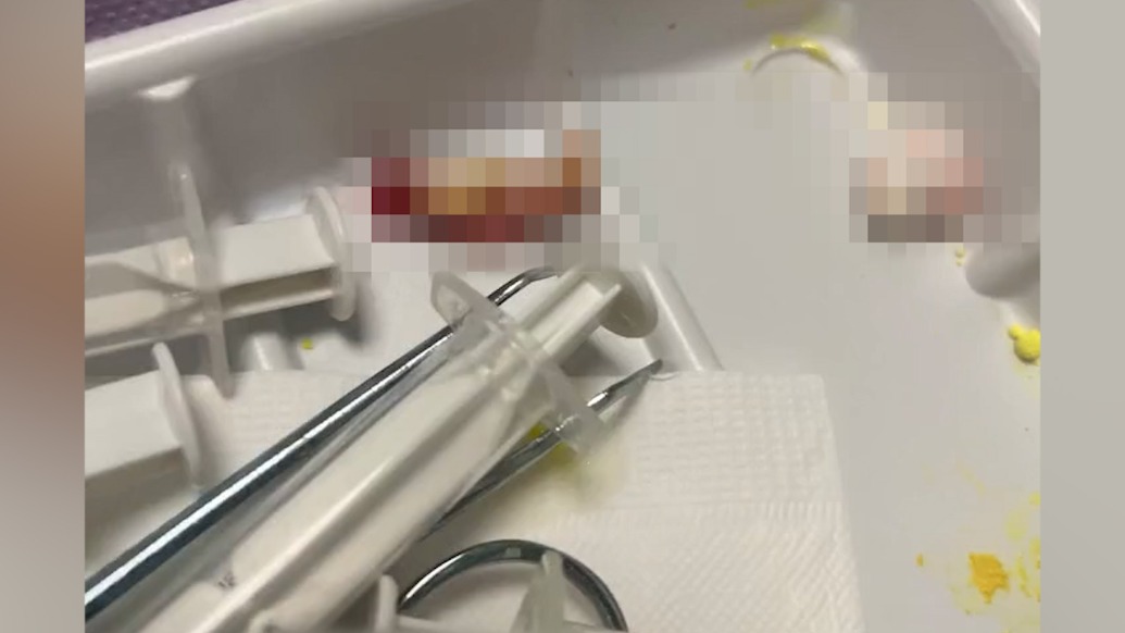 患者拔牙后医生把棉球缝进伤口致疼痛不止？医院：正在调查，暂无结论