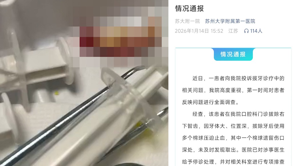 男子拔牙后持续剧痛发现遗留棉球，苏州大学附属第一医院致歉：涉事医生已停诊
