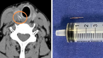 “吞飯團(tuán)去魚刺”可能很兇險(xiǎn)，醫(yī)生手術(shù)取出甲狀腺中的魚刺