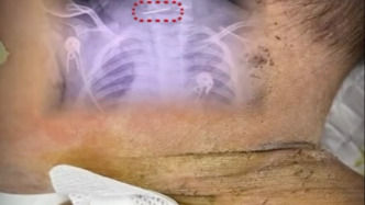 十月大男婴全身被扎针后就医？警方已介入，云南墨江多部门核查