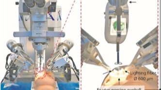 治療嚴(yán)重眼疾有了新路徑：借助機(jī)器人與人工智能，最精細(xì)的眼科手術(shù)已可實(shí)現(xiàn)部分自動(dòng)化