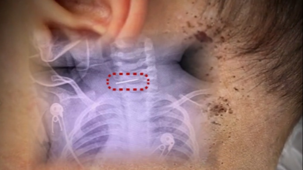 医生接诊发现“男婴颈椎藏针”，警方回应孩子生母精神状况称在开展核查