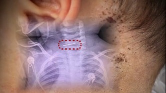 医生接诊发现“男婴颈椎藏针”，警方回应孩子生母精神状况称在开展核查