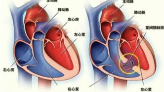 科普 | 探秘冠脉造影（一）——什么是冠脉造影？