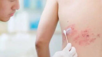 蔡依林曾自爆長期熬夜患“蛇纏腰”，細胞療法或是緩解疼痛的良好選擇