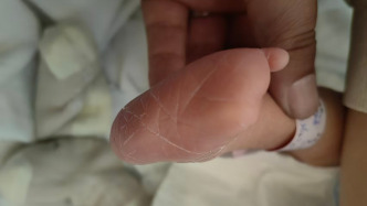 山東濱州一試管嬰兒右腳四個腳趾缺如，醫(yī)院：超聲檢查有局限性