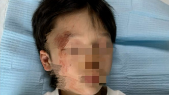 315｜孩子游乐场摔倒脸部缝4针，商家：老板正在处置