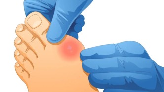 到底是“肾不好”引起血尿酸升高，还是血尿酸升高引起“肾不好”？