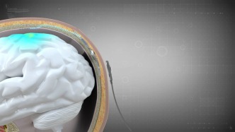 全球首款侵入式产品获批上市，中国脑机接口加速商业化