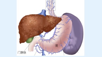 突如其来的“肝硬化”