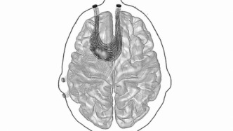 無需手術即可刺激大腦深部，新技術有望治療癲癇和其他腦病