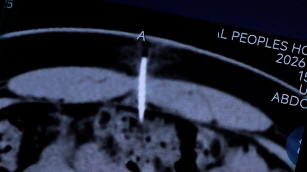 15岁男孩将缝衣针扎入腹腔，医生：患者自述系模仿游戏、视频，现已康复出院