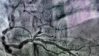 到這地步才來看病，不是心衰就是猝死