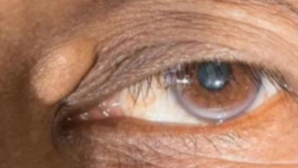 晚上洗漱完，對著鏡子看一下眼睛，這幾種變化可能是大病在報警