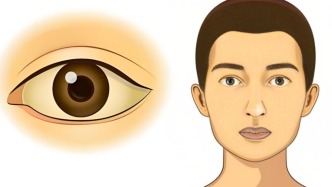 肝病為何會“變臉”？