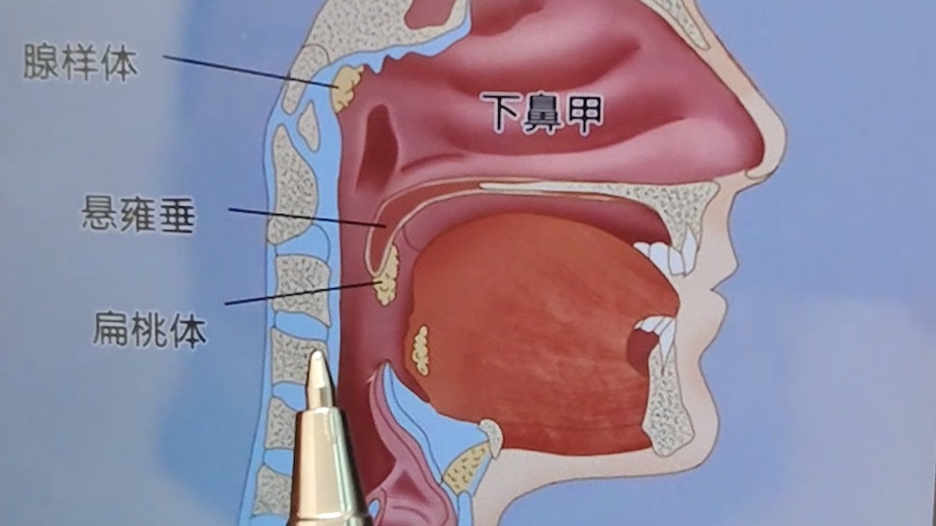 平均每小时呼吸暂停44次，10岁儿童睡觉总憋醒确诊重度呼吸暂停