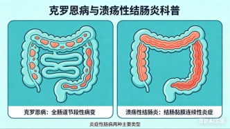 為什么近年來(lái)炎癥性腸病的孩子越來(lái)越多？