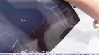 女子术后11年发现螺钉遗留，医院承认医生失误不认医疗事故赔4500元，常州新北卫健局回应