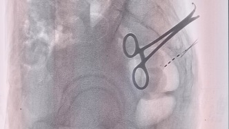 83岁老人被神经性便秘折磨3个月，微创术后2天就通畅