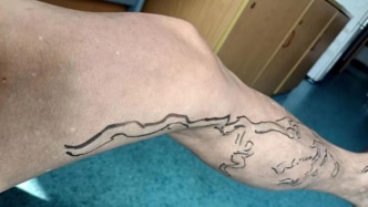 腿上的血管彎彎曲曲，有呼之欲出、只一層薄皮包裹的感覺