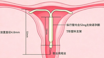  告別“血崩”與反復(fù)手術(shù)，曼月樂(lè)環(huán)是“神器”還是“隱患”？ 