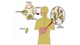 吃了一顿鱼生，虫子在体内住了20年