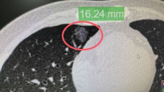 震惊！72岁大爷肺里纯磨玻璃结节拖了2年，切出来竟是这种“狡猾”癌！